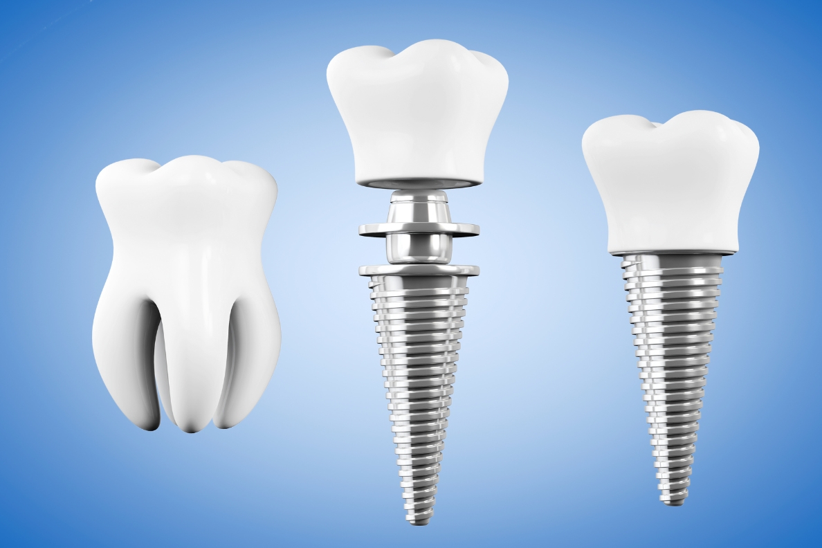 dental implant