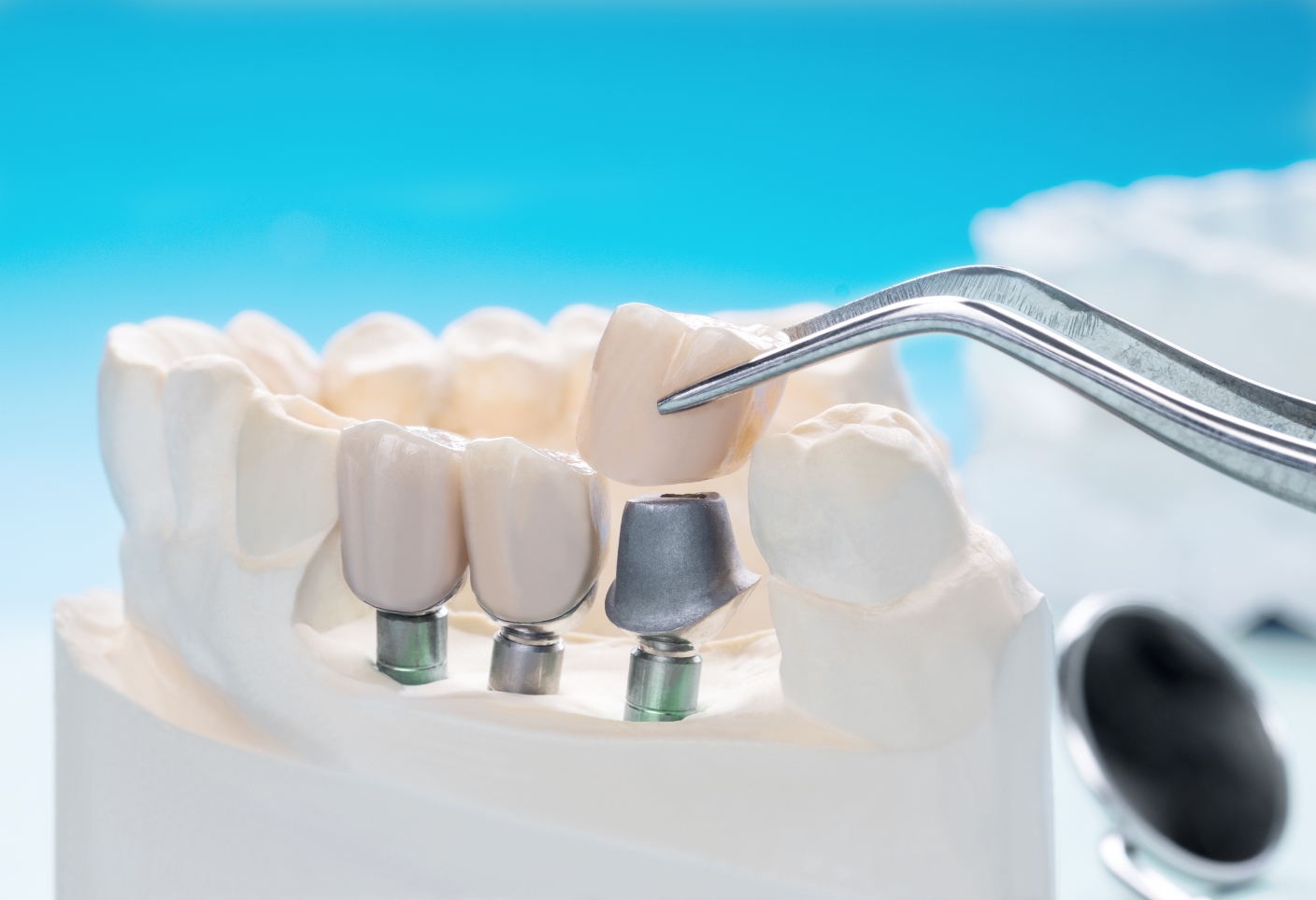 dental implants in khammam